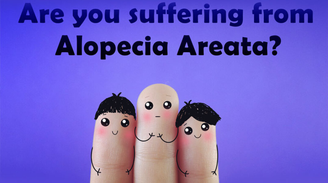 Αίτια, συμπτώματα και αντιμετώπιση της γυροειδούς αλωπεκίας 