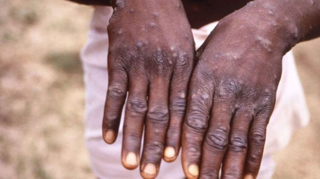 Ευλογιά των πιθήκων: Χέρια με τα σημάδια της νόσου
