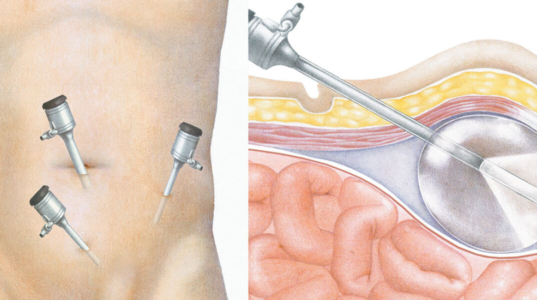 Εικονογράφηση λαπαροσκοπικής αντιμετώπισης της κήλης