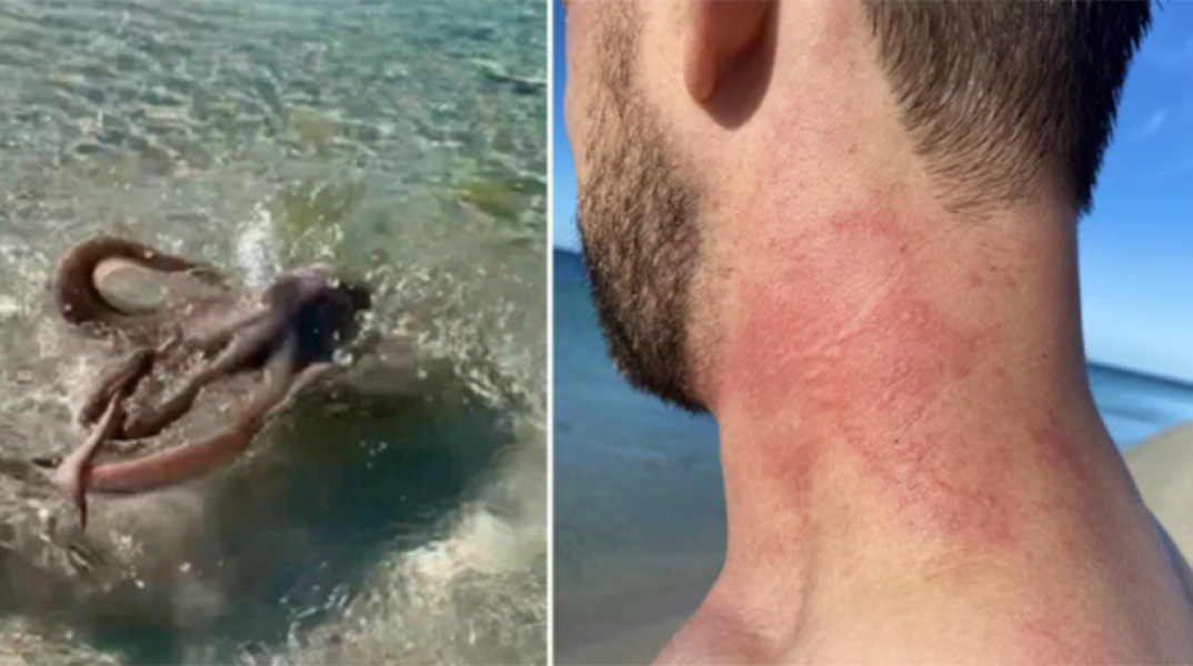 Αυστραλία: Το «πιο θυμωμένο χταπόδι» επιτίθεται σε τουρίστα 