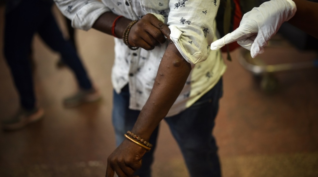 Ευλογιά των πιθήκων - Γυναίκα που ελέγχεται για συμπτώματα στο κορμί της