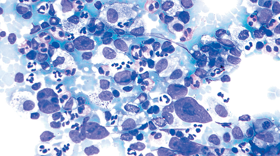 μη-Hodgkin λέμφωμα (ΜΗΛ)