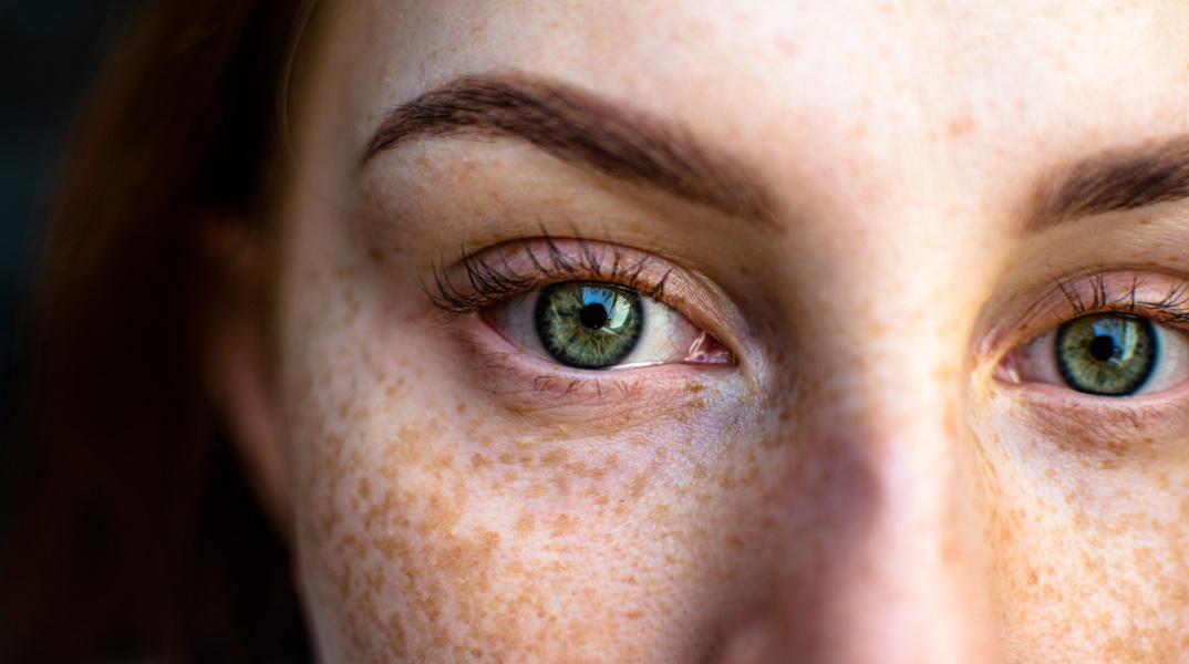 Οφείλονται στον ήλιο οι άσπρες κηλίδες στο δέρμα;