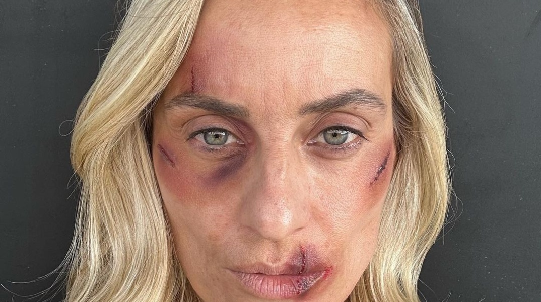 Η Ελεονώρα με μώλωπες στο πρόσωπό της ως θύμα κακοποίησης
