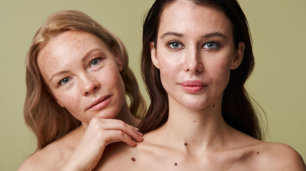 Πώς ο Σακχαρώδης Διαβήτης επηρεάζει την υγεία της επιδερμίδας σου