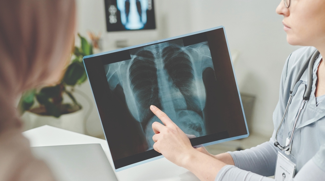 Καρκίνος του Πνεύμονα: Οι νέες θεραπευτικές προσεγγίσεις