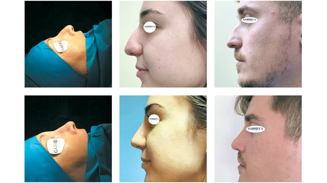 Αισθητική και λειτουργική αναβάθμιση της μύτης με τη νέα κλειστή ρινοπλαστική