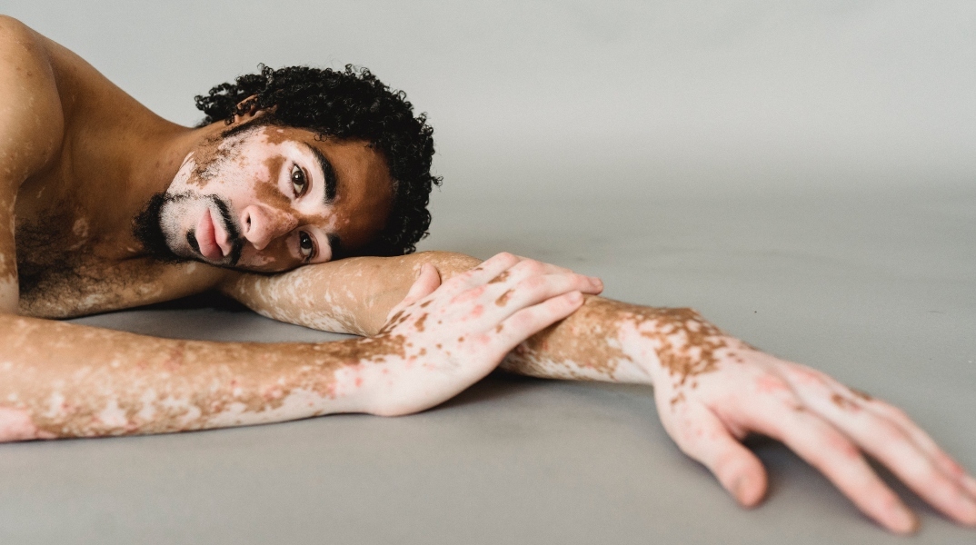 Τι είναι οι αυτοάνοσες ασθένειες και γιατί ακούμε γι’ αυτές όλο και περισσότερο