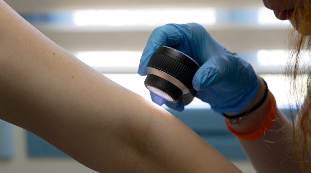 Μελάνωμα: Δωρεάν έλεγχος σπίλων σε 4 ακριτικά νησιά 