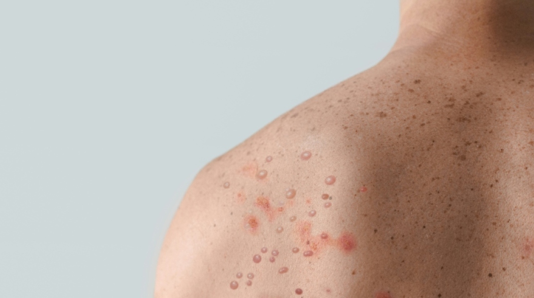 Νέα επιδημία mpox: Θα κάνουμε τα ίδια λάθη;   