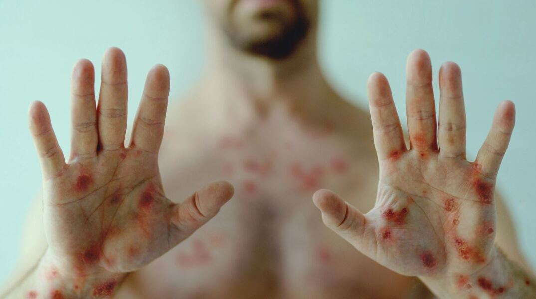 Ευλογιά των Πιθήκων: Ο ΠΟΥ ξεκαθαρίζει πως η mpox δεν είναι η νέα covid