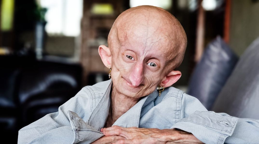 Πέθανε η 19χρονη που έπασχε από πρόωρη γήρανση 