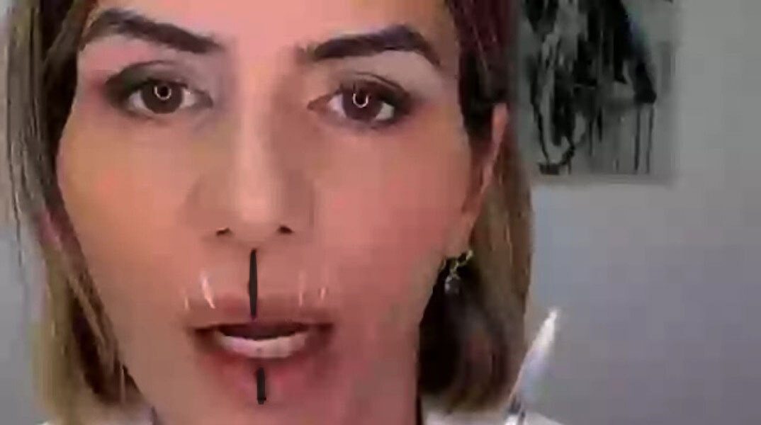 Έκανε μπότοξ στο μισό της πρόσωπο για να δείξει τα αποτελέσματα της θεραπείας 