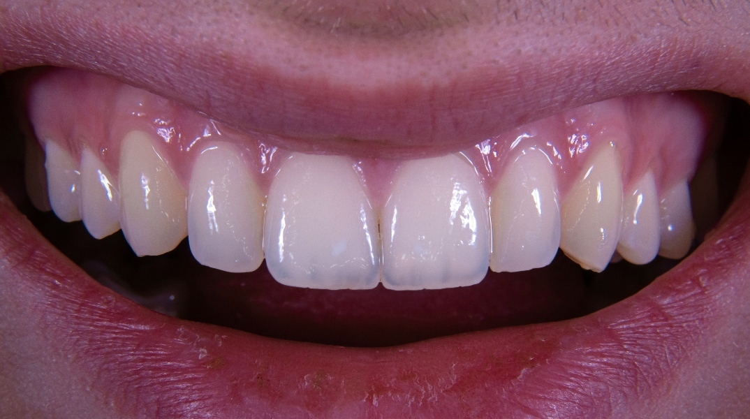 Τι είναι το χαμόγελο Ozempic 