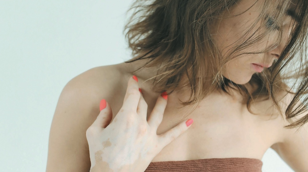 Λεύκη: Σύμμαχος ο δερματολόγος