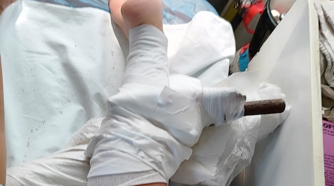 Τραυματισμός - σοκ για 26χρονη στη Χαλκιδική - Ομπρέλα θαλάσσης καρφώθηκε στο πόδι της