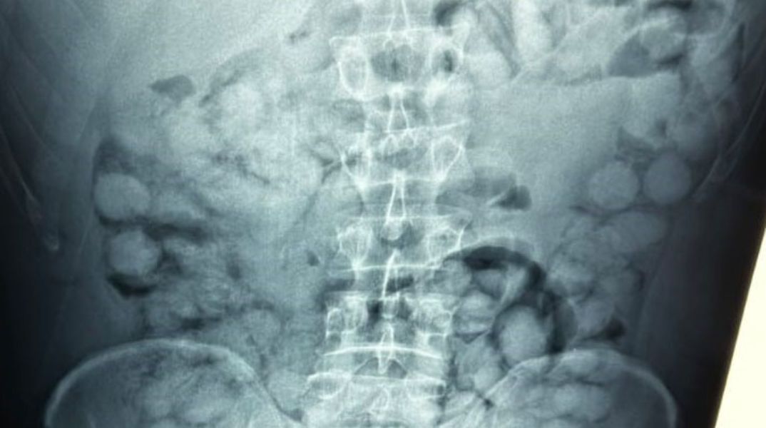 Ελ. Βενιζέλος: Συνελήφθη άνδρας που είχε καταπιεί 100 συσκευασίες κοκαΐνης