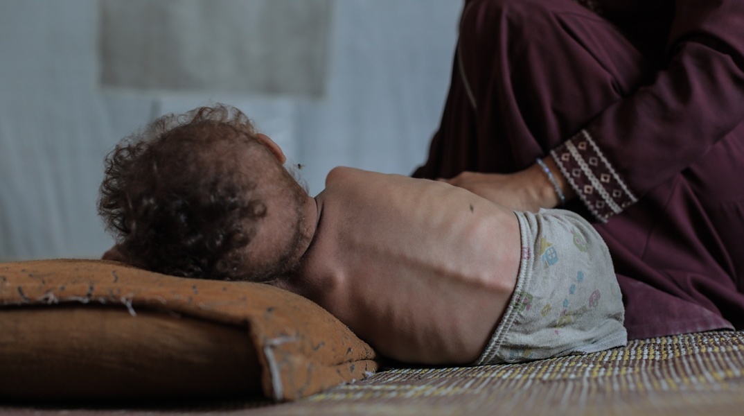 Μωρό αδυνατισμένο σε κρεβάτι στη Γάζα