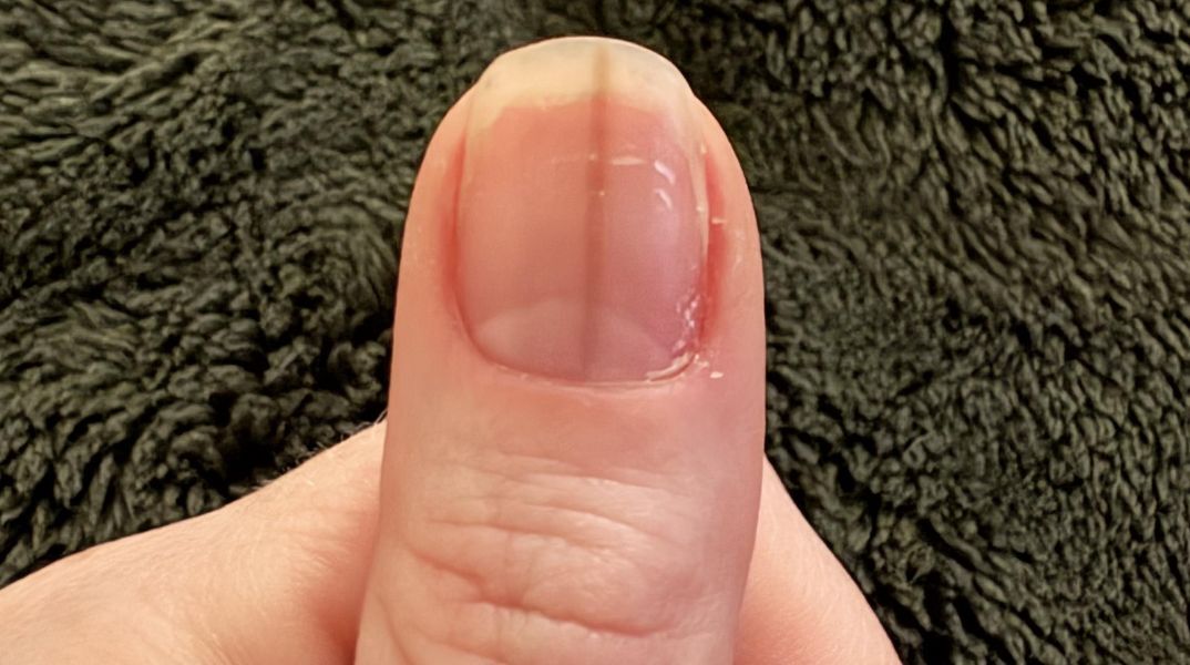Γυναίκα ανάρτησε στο Reddit φωτογραφία με σκούρα γραμμή στο νύχι της - Οι χρήστες προειδοποίησαν ότι μπορεί να σχετίζεται με μελάνωμα.