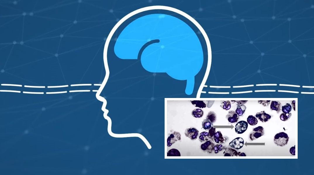 Άνδρας στο Μιζούρι πέθανε από σπάνια λοίμωξη που προκαλεί η αμοιβάδα Naegleria fowleri, η οποία εισέρχεται στον οργανισμό από τη μύτη.