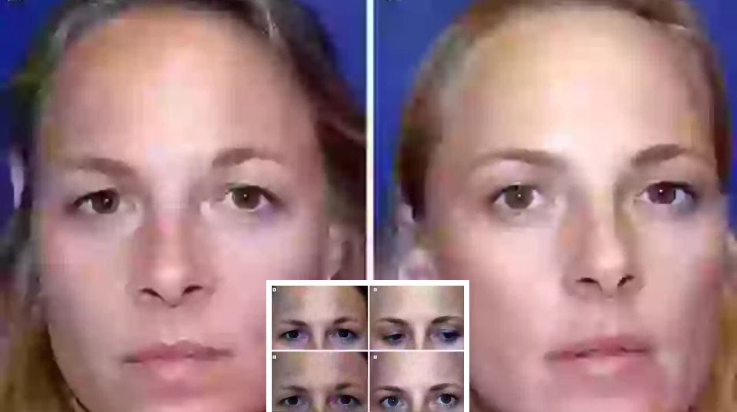 Μελέτη σε αποκαλύπτει τις μακροχρόνιες επιπτώσεις του μπότοξ - Επιστήμονες παρακολούθησαν δύο δίδυμες αδελφές επί 20 χρόνια