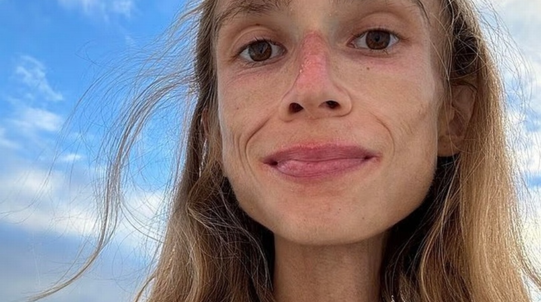 Το τραγικό τέλος της φοιτήτριας που αντιμετώπιζε διατροφικές διαταραχές και πίστεψε ότι η θεραπεία ήταν η φρουτοφαγία