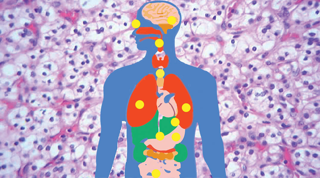 VHL σύνδρομο: Πώς είναι να ζεις με ένα σπάνιο νόσημα στην Ελλάδα του σήμερα