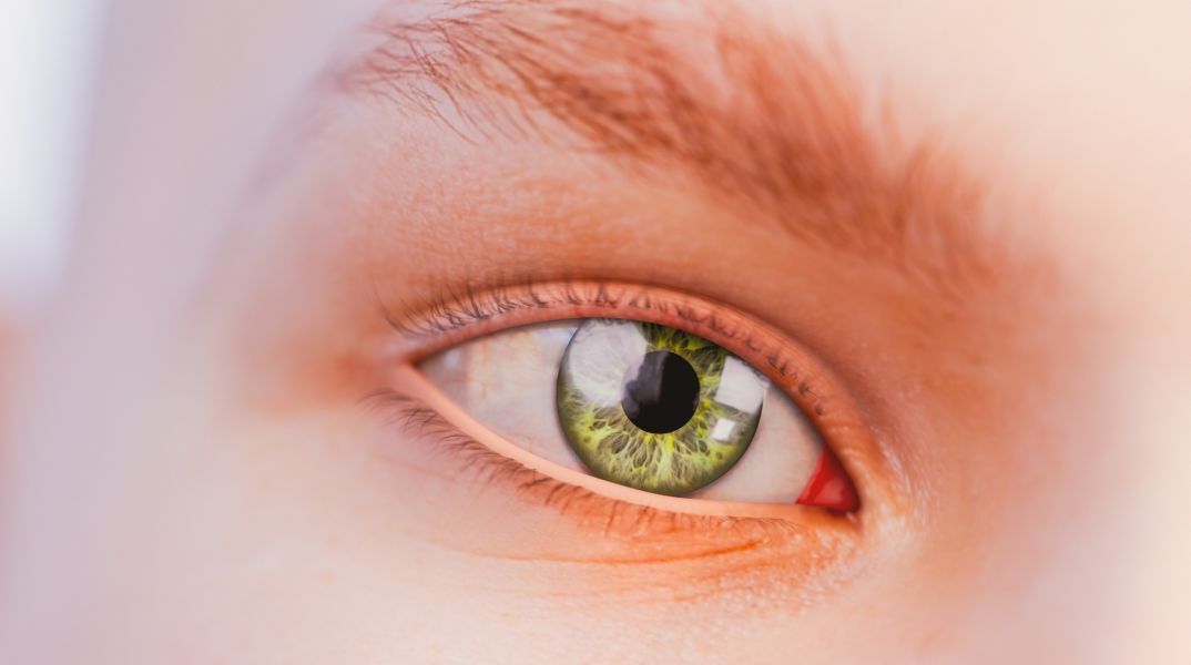 Ένας περίεργος δακτύλιος στην ίριδα του ματιού μπορεί να δείχνει συσσώρευση χαλκού ή αρχόμενη κερατόκωνο, δύο σπάνιες παθήσεις με σοβαρές επιπτώσεις στην υγεία.