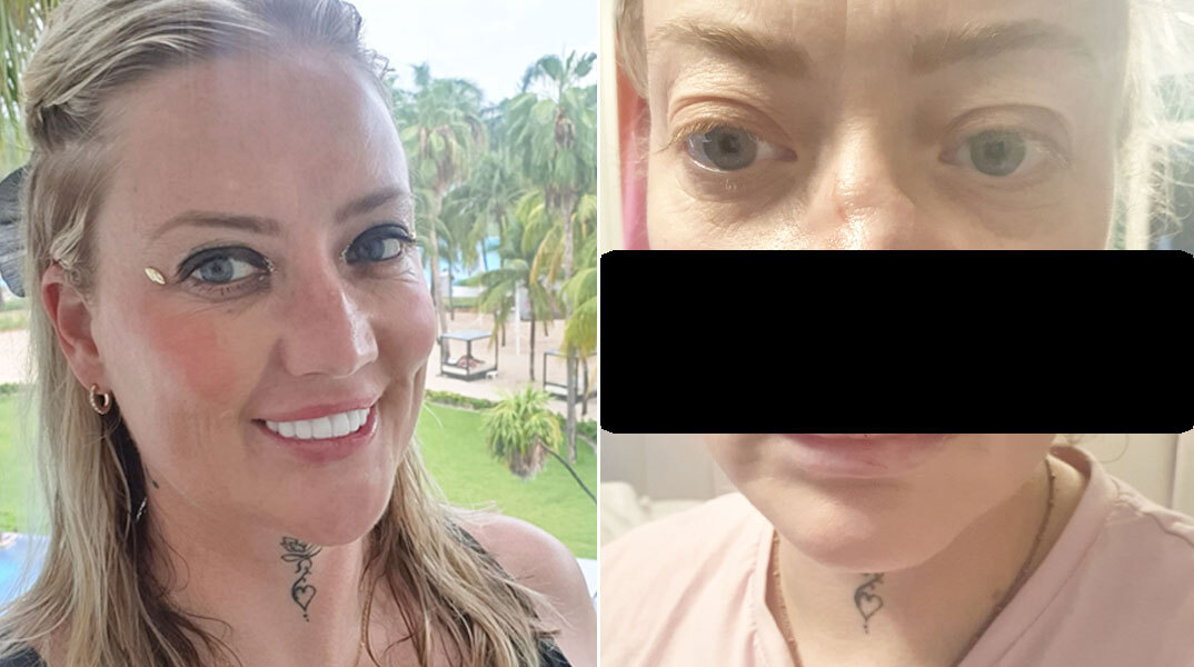 Γυναίκα γυρίζει σχεδόν χωρίς πρόσωπο μετά από οδοντική επέμβαση στην Τουρκία