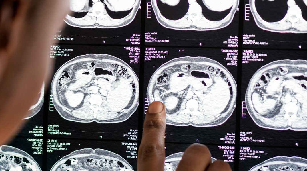 Καρκίνος: Εννιά εξετάσεις που πρέπει να κάνει κάθε ενήλικας για την πρόληψή του 