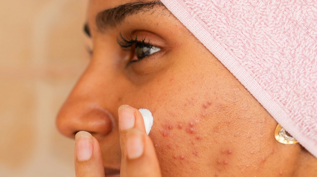 Κάποια σπυράκια απλώς δεν τα ακουμπάμε! 