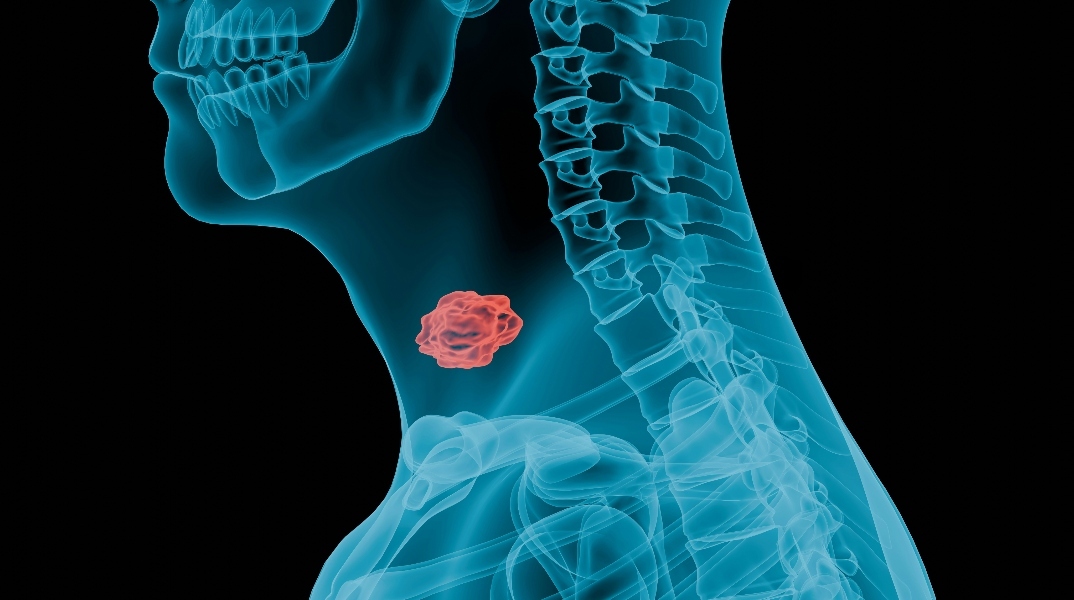 Γιατί έχουν αυξηθεί τα περιστατικά καρκίνου του λάρυγγα από στοματικό έρωτα τα τελευταία χρόνια 