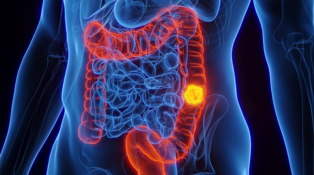 Αύξηση καρκίνου παχέος εντέρου σε νέους: ρόλος παχυσαρκίας, τρόπου ζωής, μικροβιώματος και «μεταβολικής παγίδας» στην πρώιμη νόσο.