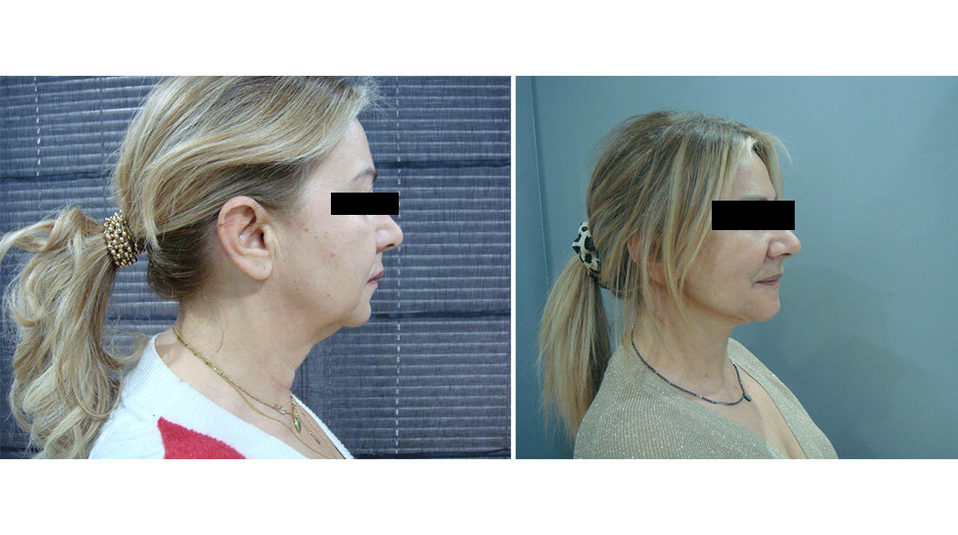 Deep Plane Face & Neck Lift