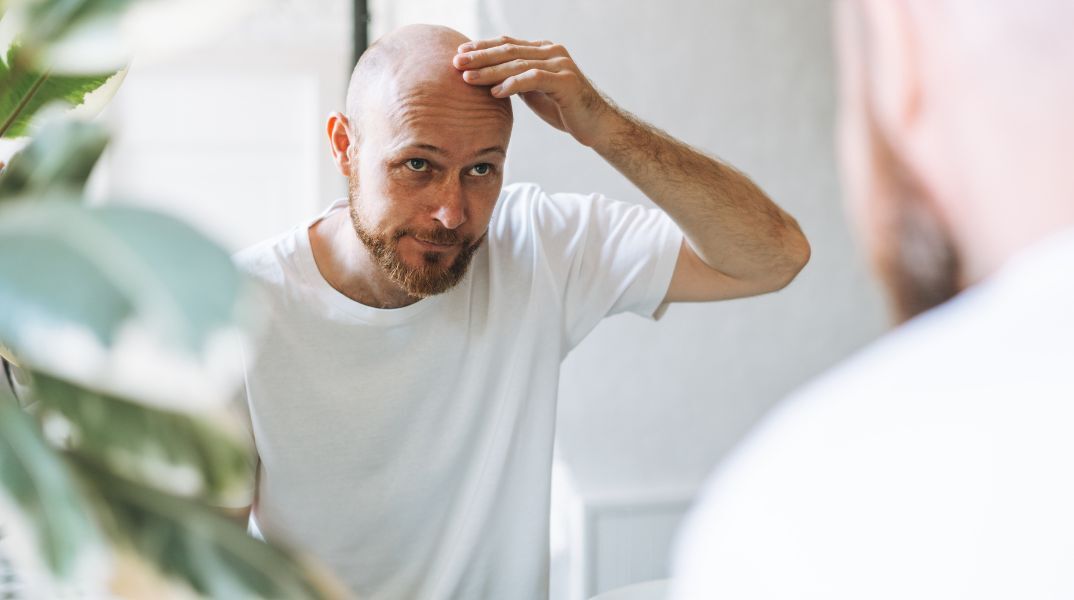 Νέα έρευνα χαρτογραφεί τα ποσοστά ανδρικής φαλάκρας παγκοσμίως - Η Ευρώπη κυριαρχεί στην κορυφή, οι ασιατικές χώρες εμφανίζουν τα χαμηλότερα ποσοστά.