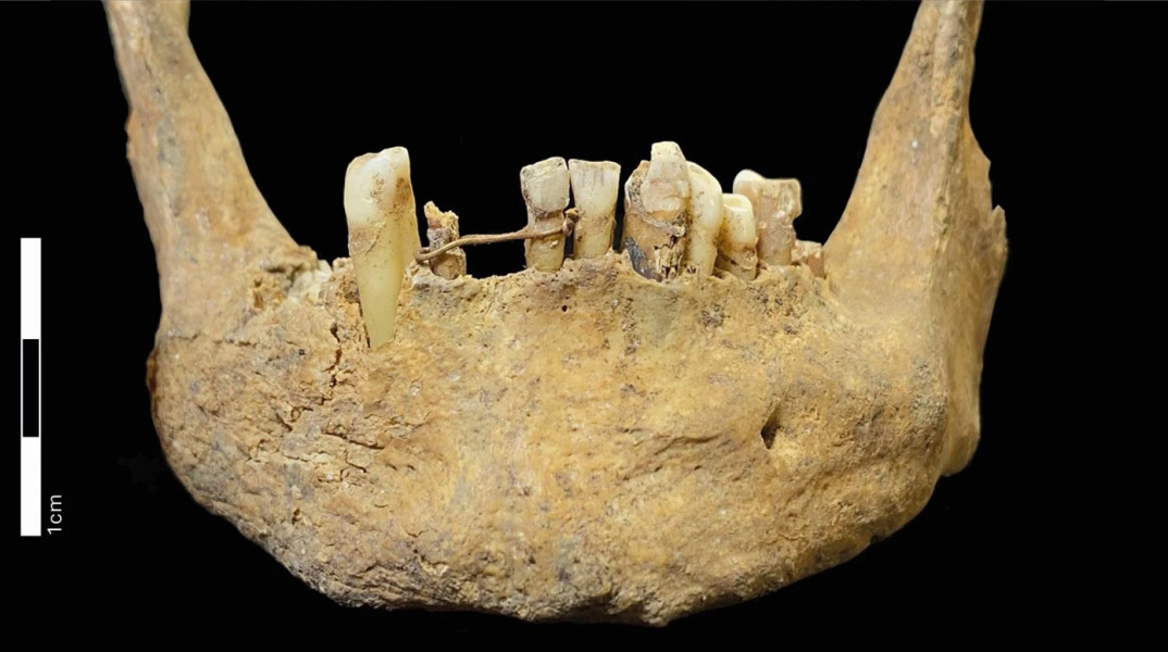 Βρέθηκε χρυσό σύρμα σε κρανίο 500 ετών - Η απίστευτη οδοντιατρική μέθοδος που ήρθε στο φως