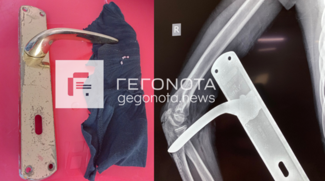 Πόμολο καρφώθηκε στο χέρι μαθητή Δημοτικού