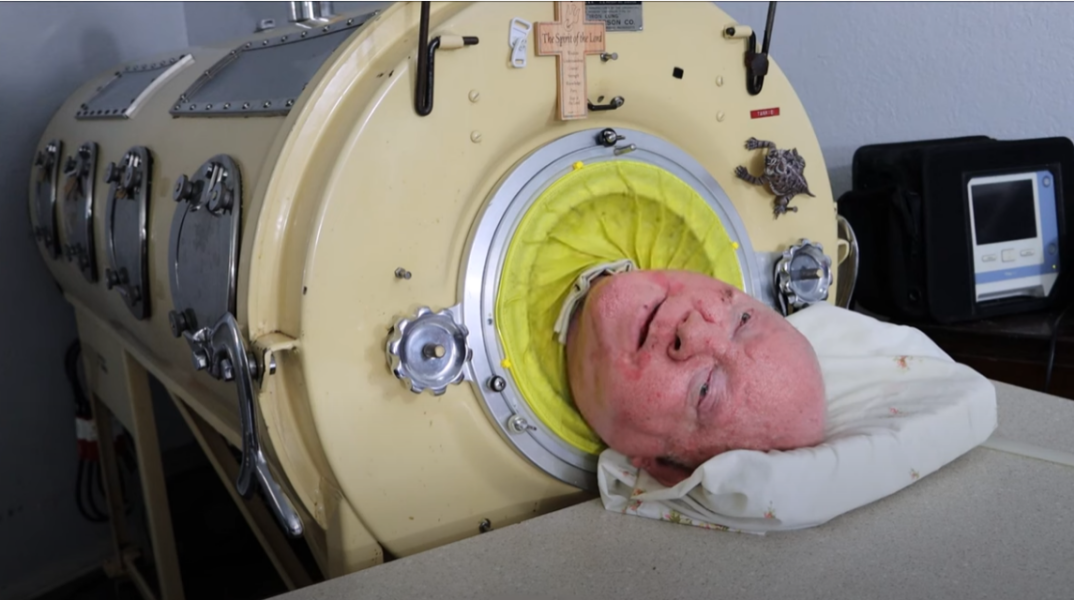 Ο Paul Alexander ζούσε σε σιδερένιο πνεύμονα