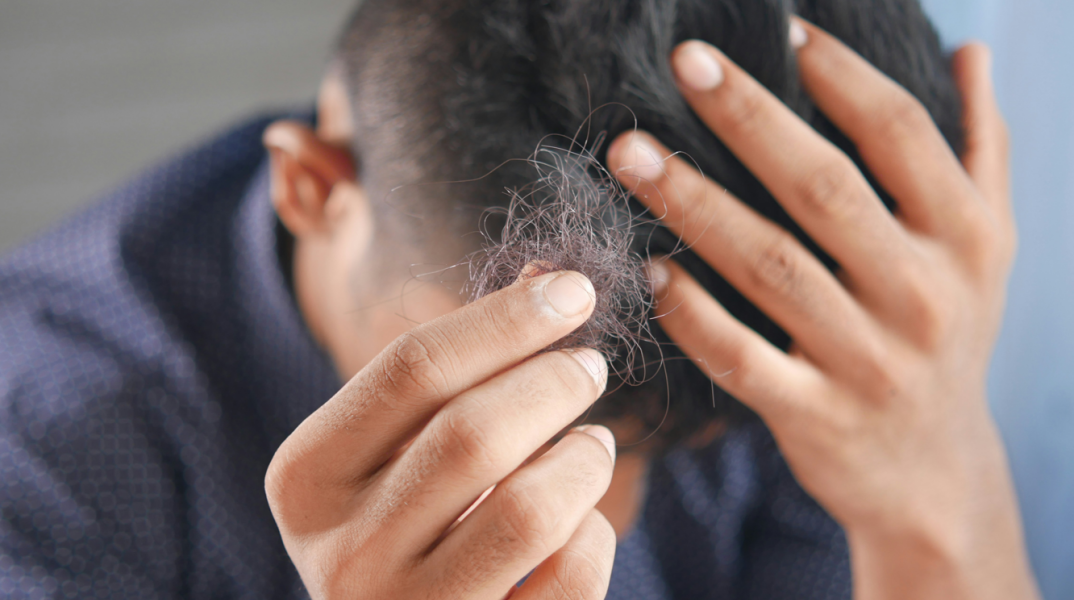 Επιστήμονες ανακάλυψαν επαναστατική «θεραπεία» για την τριχόπτωση που δρα σε μόλις 20 ημέρες - Πώς λειτουργεί