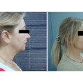 Deep Plane Face & Neck Lift