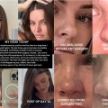 Οι εικόνες που δημοσίευσε influencer πριν και μετά την εγχείρησή της στη μύτη