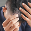 Επιστήμονες ανακάλυψαν επαναστατική «θεραπεία» για την τριχόπτωση που δρα σε μόλις 20 ημέρες - Πώς λειτουργεί