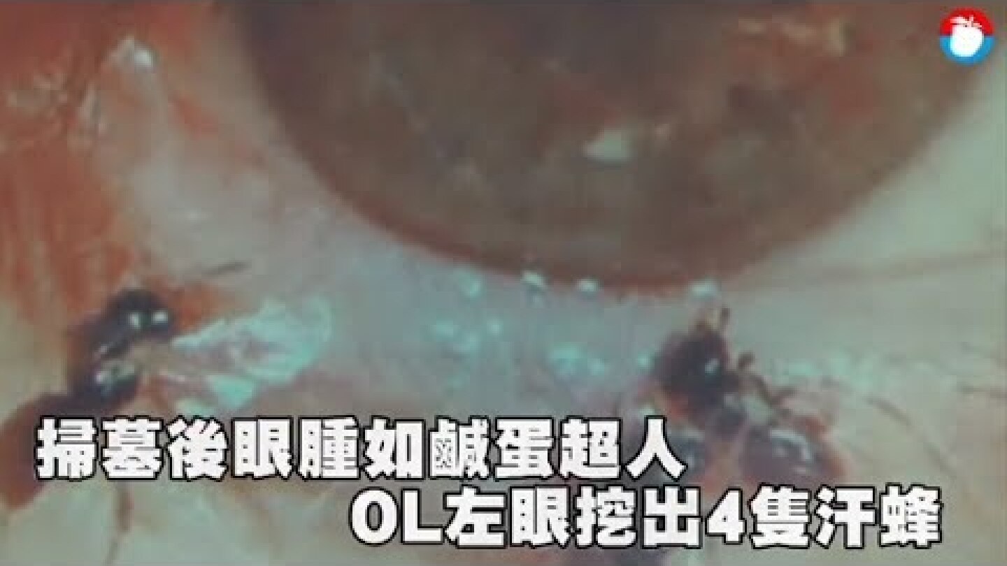 好驚悚！OL掃墓後眼腫如鹹蛋超人　左眼竟挖出4隻汗蜂 | 蘋果新聞網