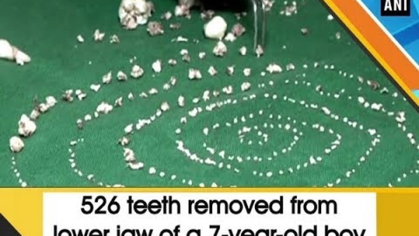 526 teeth removed from lower jaw of a 7-year-old boy