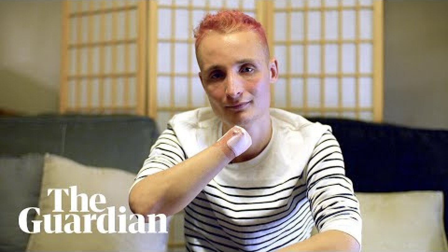 Gilets jaunes protesters mutilated by police weapons: 'My hand was hanging from my wrist'