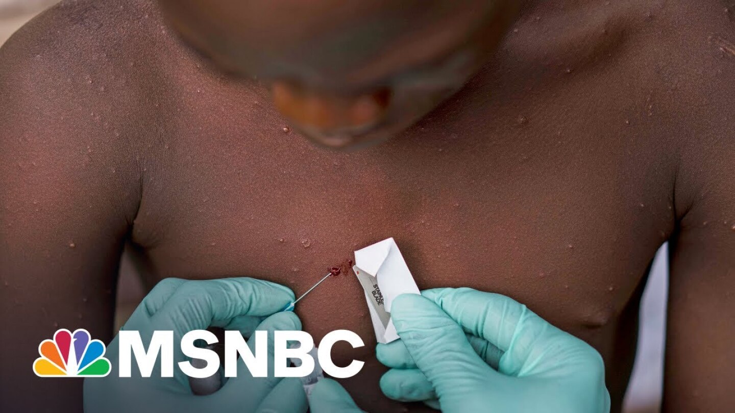 Monkeypox Virus: What You Need To Know