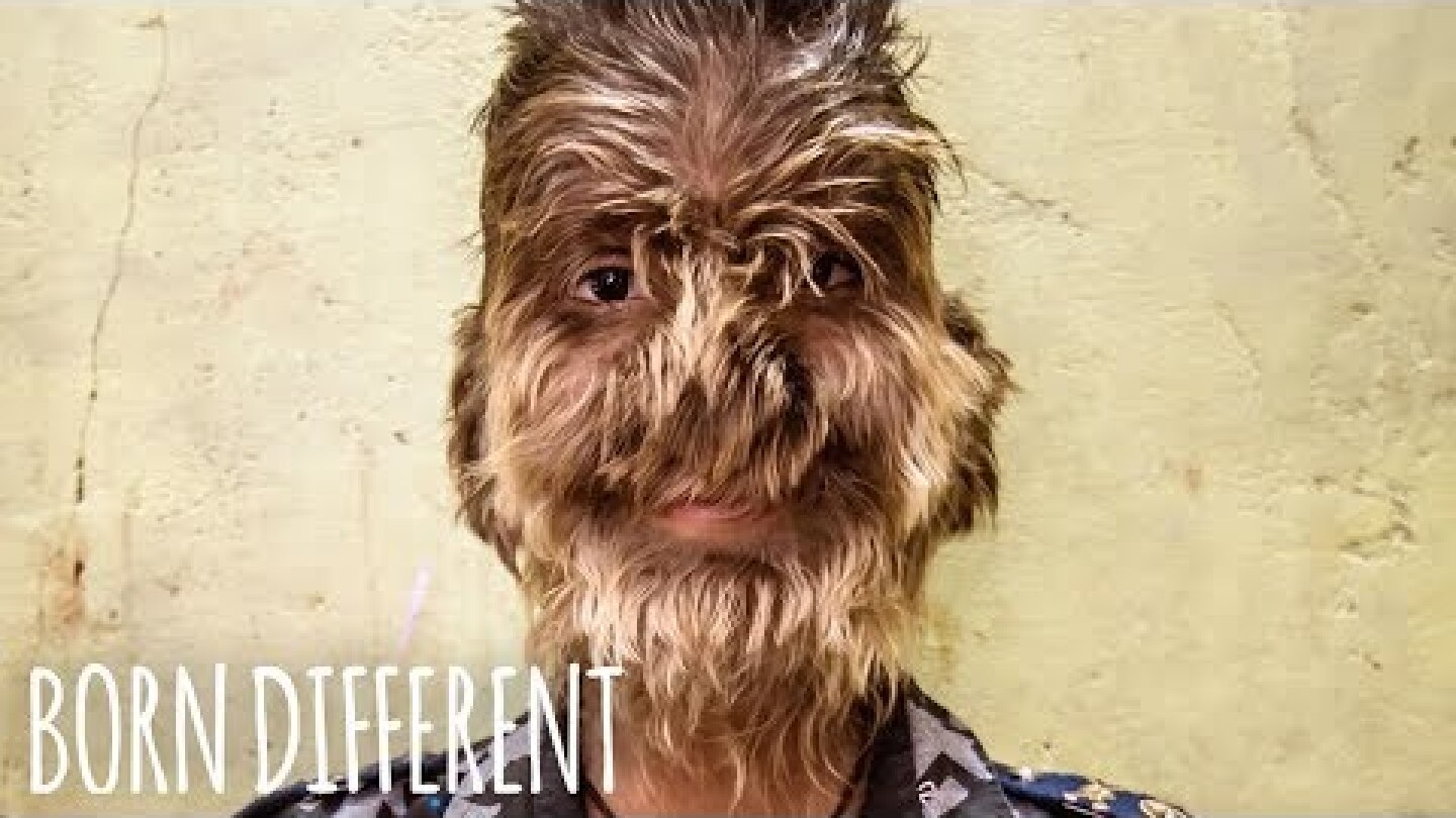 The Boy With ‘Werewolf Syndrome’ | BORN DIFFERENT