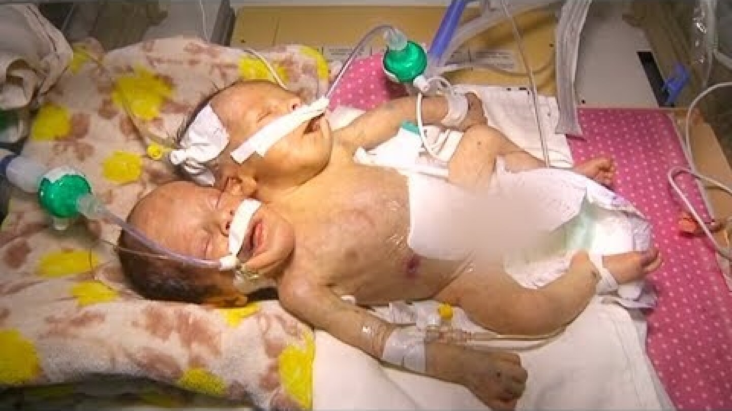 Conjoined twins in Yemen need international support to survive