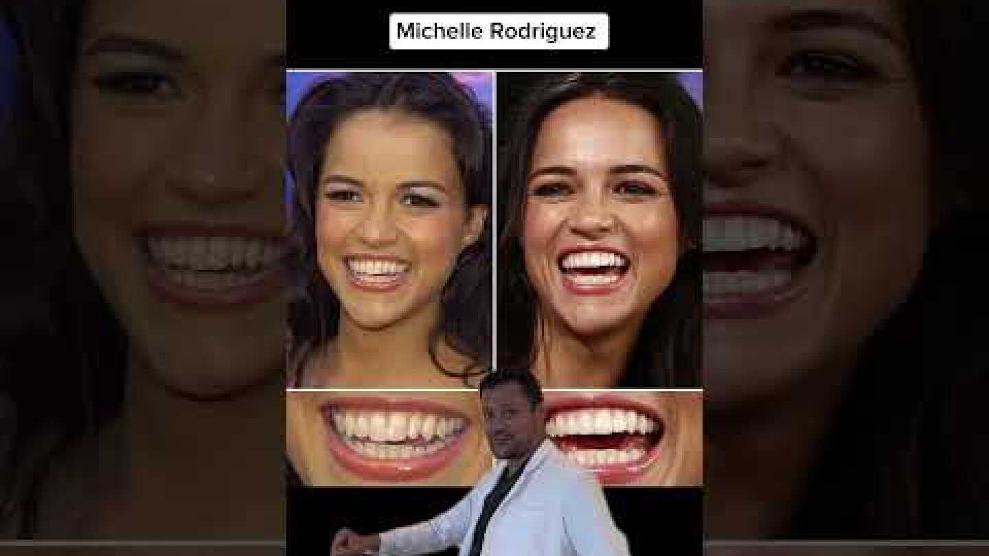 Celebrities with Veneers 👆🦷 #celebrity #celebritytransformations #veneers  #celebrity #teeth