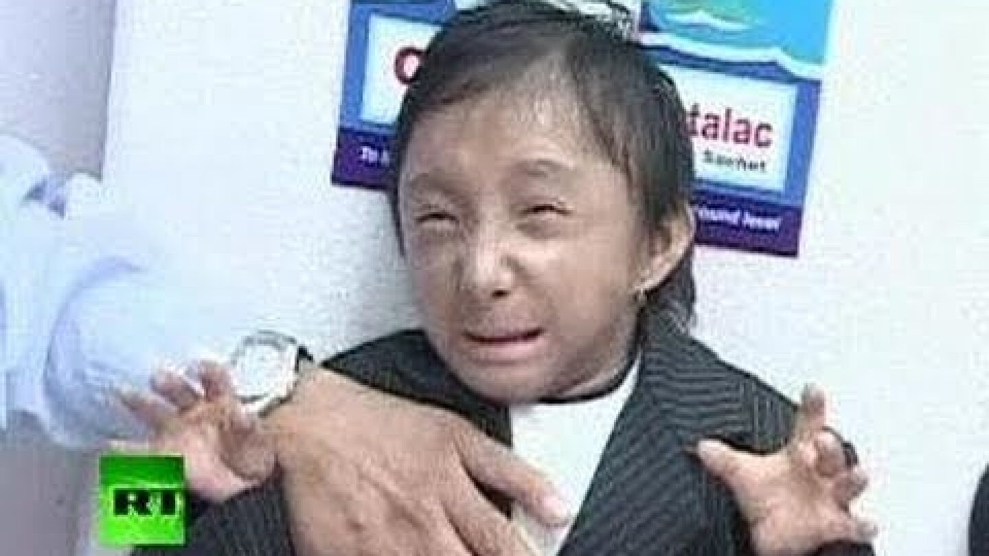 New World's Shortest Man: Nepal teen breaks record on 18th birthday